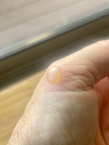 A blister.